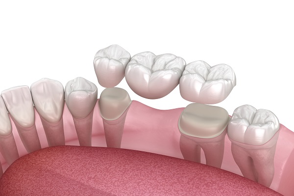 Understanding The Benefits Of Dental Bridge