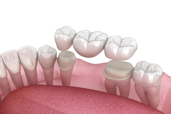 Understanding The Benefits Of Dental Bridge