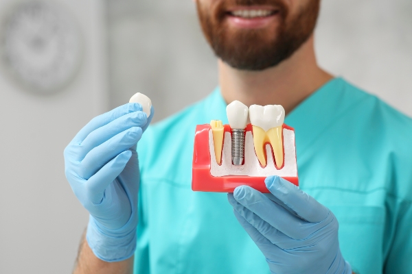 Can All My Teeth Be Replaced With Implants?