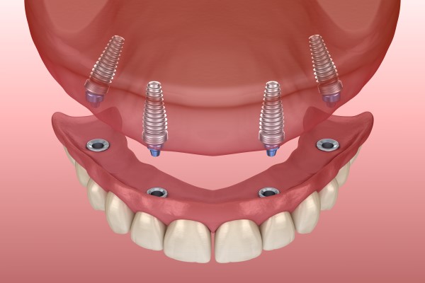 The Longevity Of Implant Supported Dentures